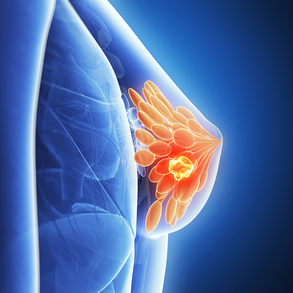 Breast Cancer - Causes, diagnosis and treatment